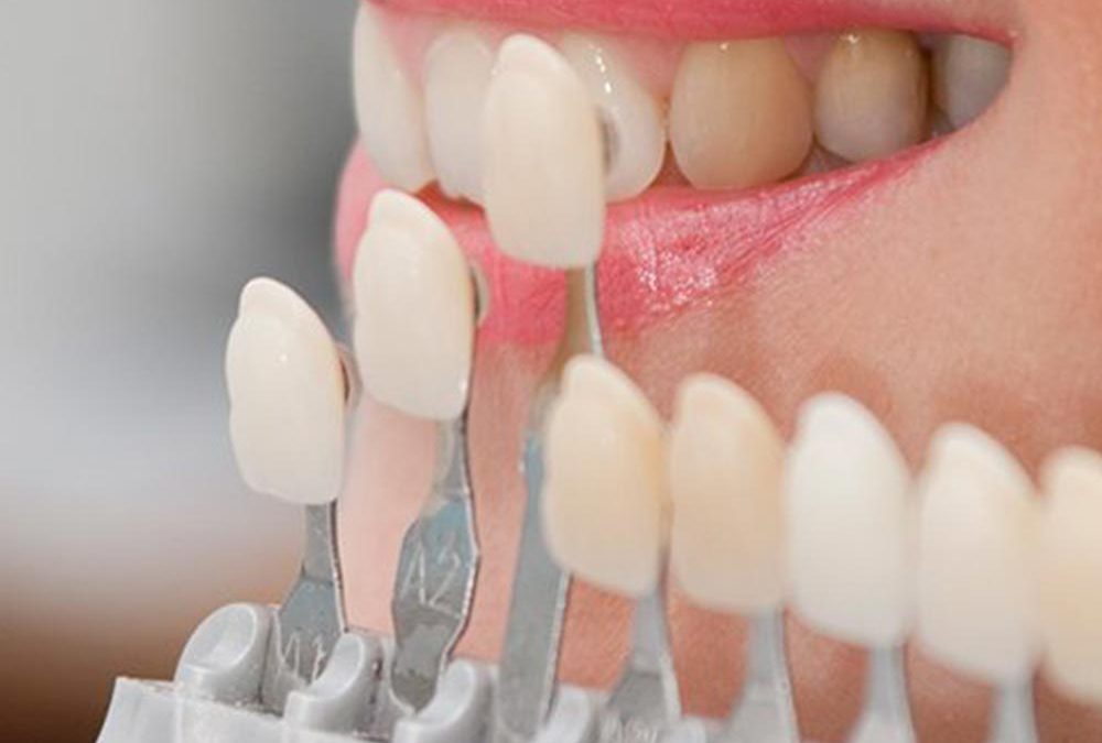 The Fundamentals of Teeth Whitening | Suncoast Dental