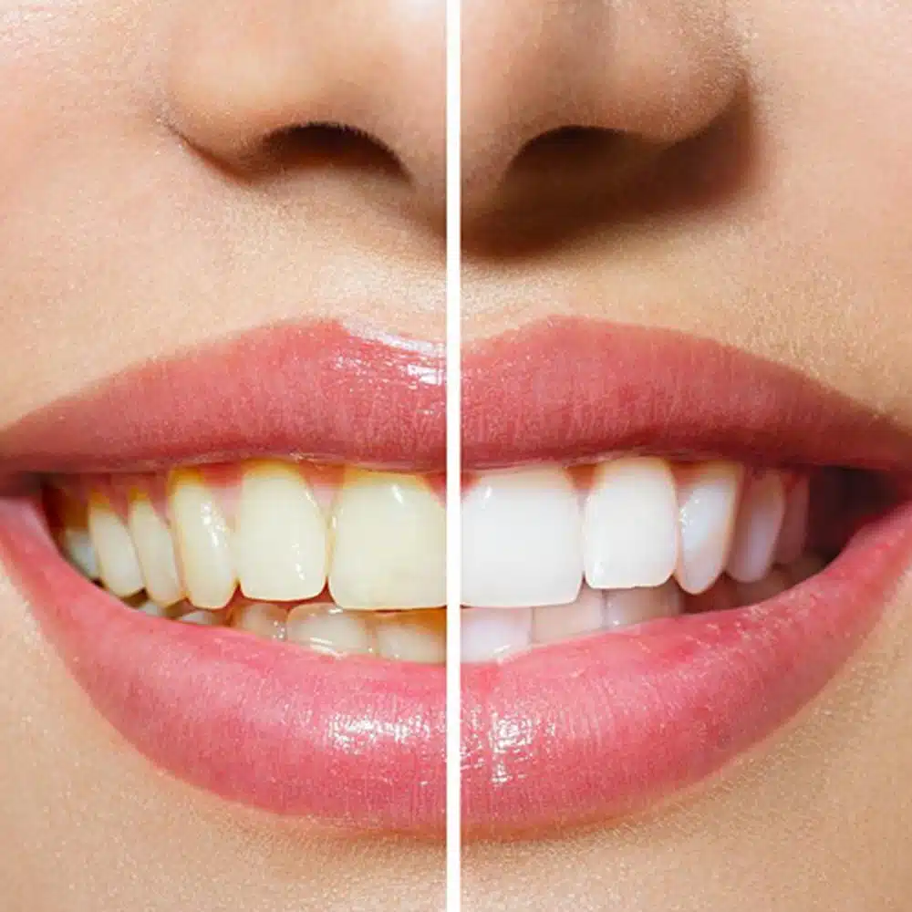Cosmetic Dentistry — Suncoastdental In Maroochydore, QLD