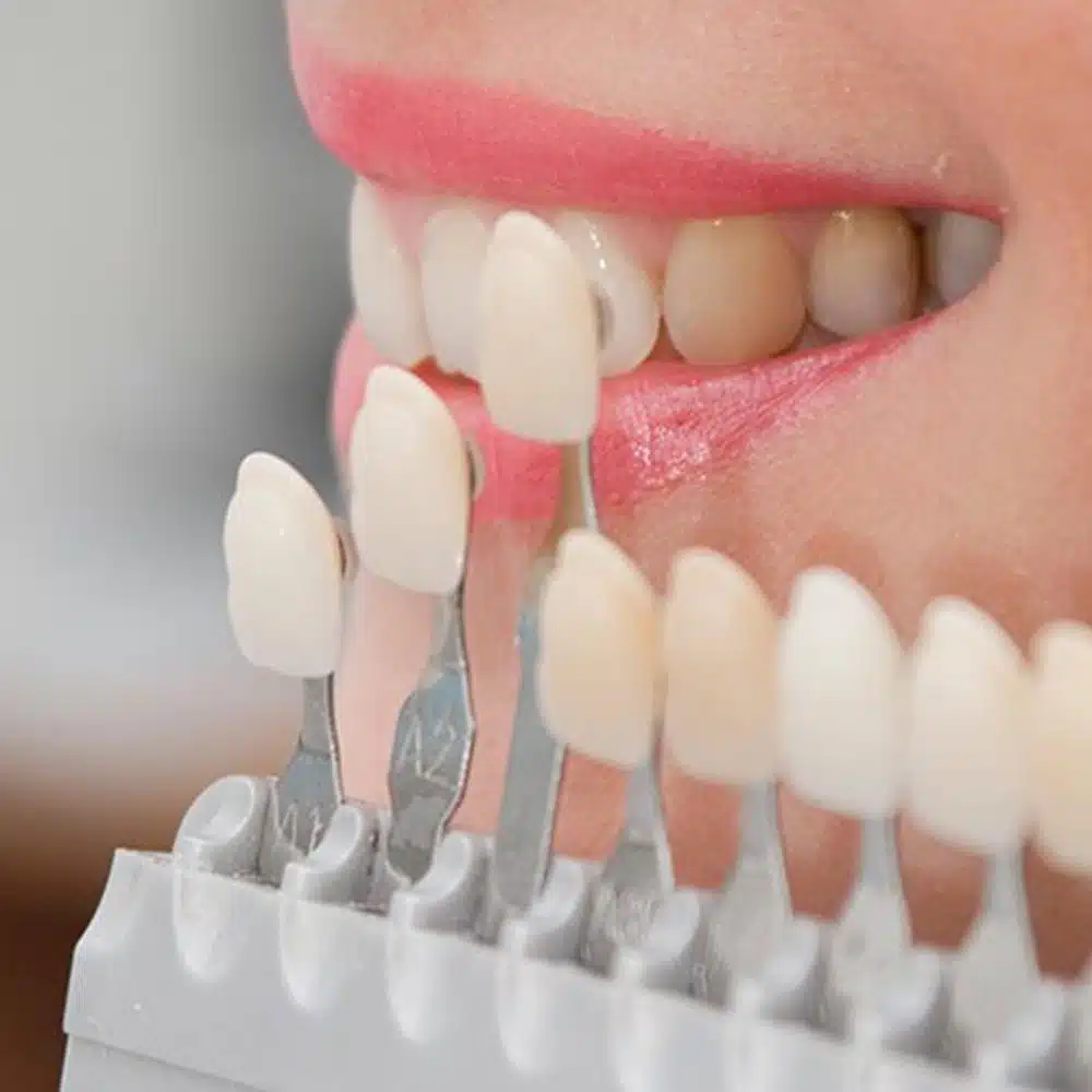 Veneers — Suncoastdental In Maroochydore, QLD