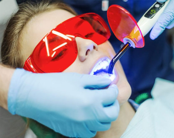 Teeth Whitening Procedure — Suncoastdental In Maroochydore, QLD