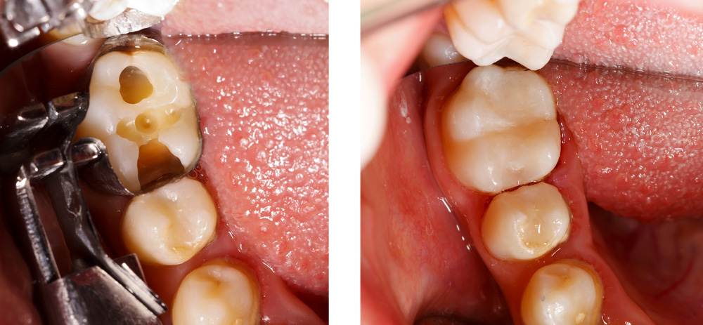 Before and After Tooth Filling — Suncoastdental In Maroochydore, QLD