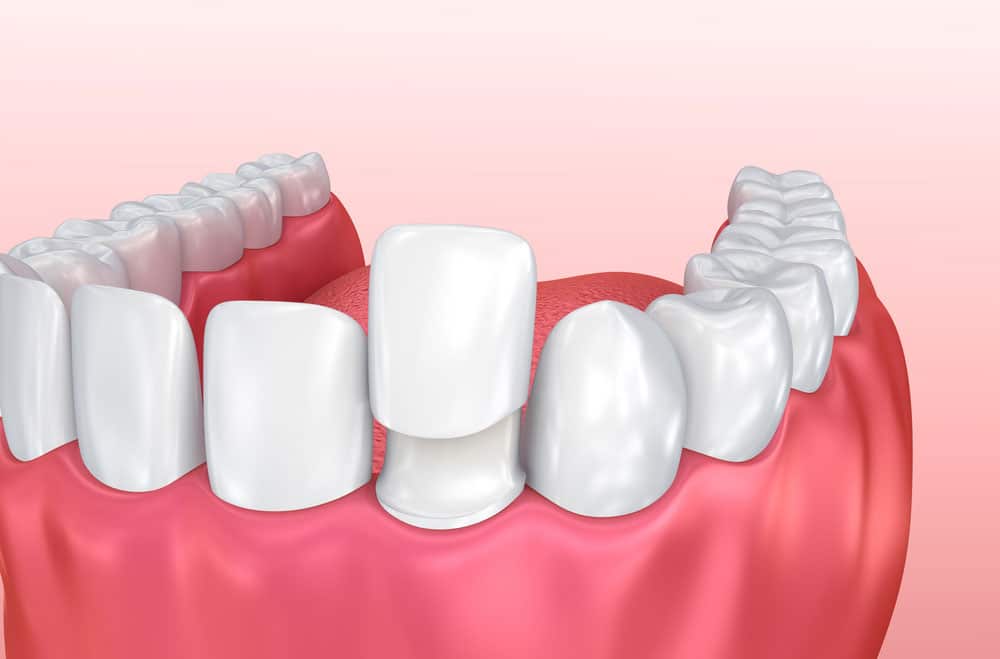 Dental Veneer Installation Procedure — Suncoastdental In Maroochydore, QLD