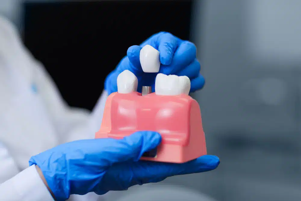 Dentist Holding Model Of Teeth With Dental Implant