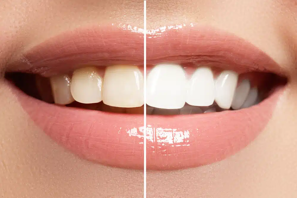 Before And After Teeth Whitening Treatments