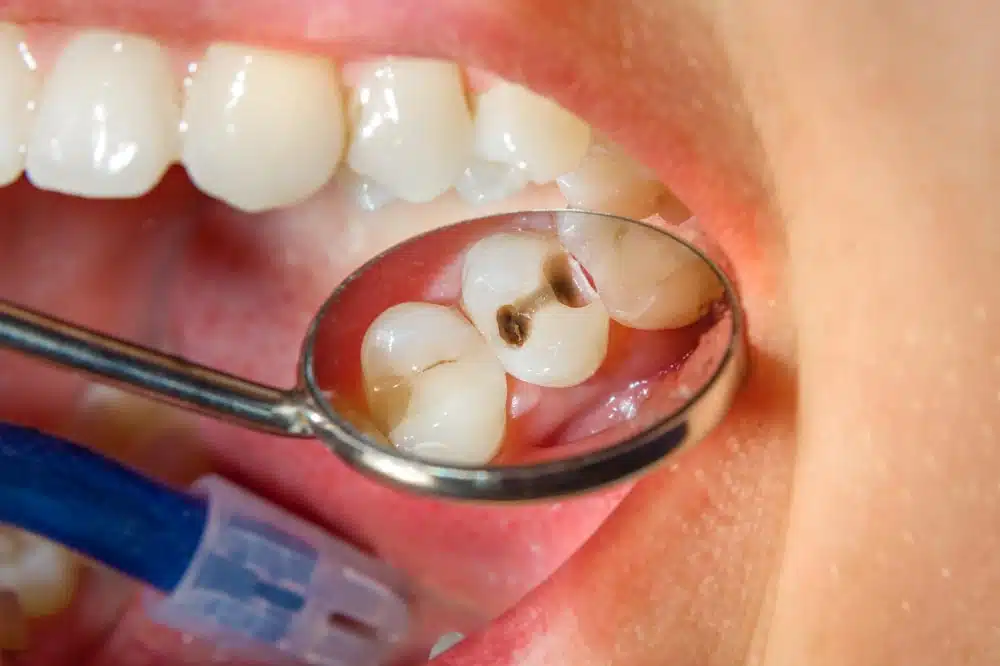 Dental Check Up With Patient Having Tooth Decay