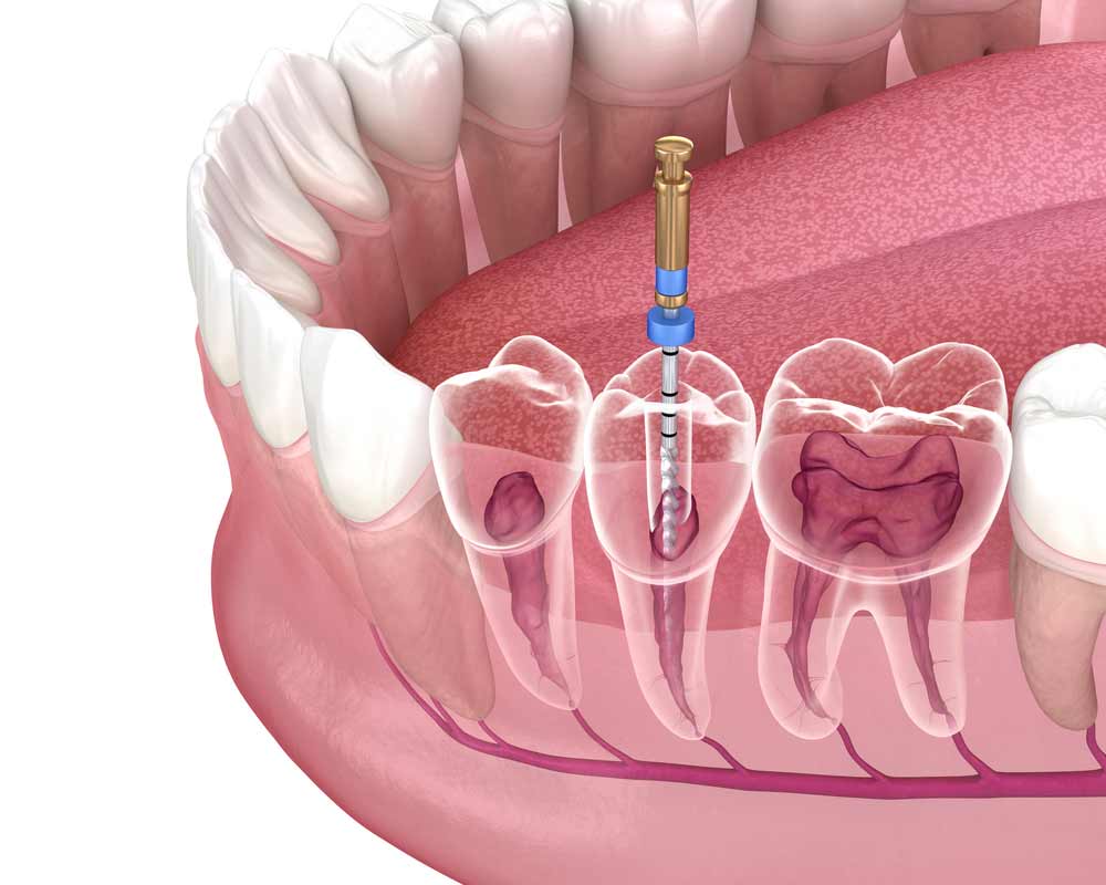 Root Canal Tooth 3D Illustration