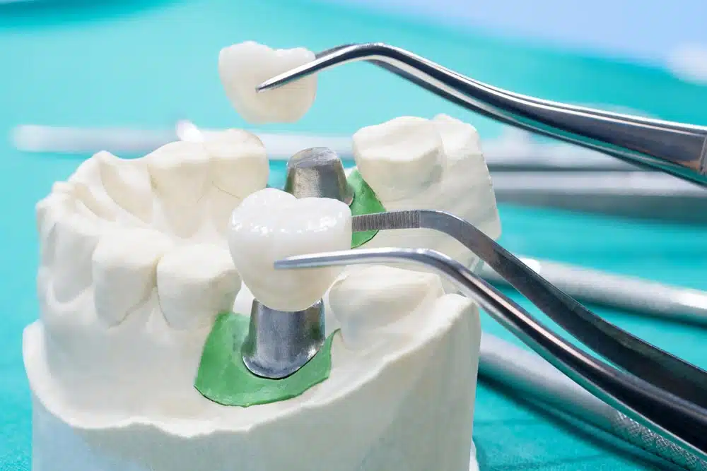 Teeth Model To Display Dental Implants