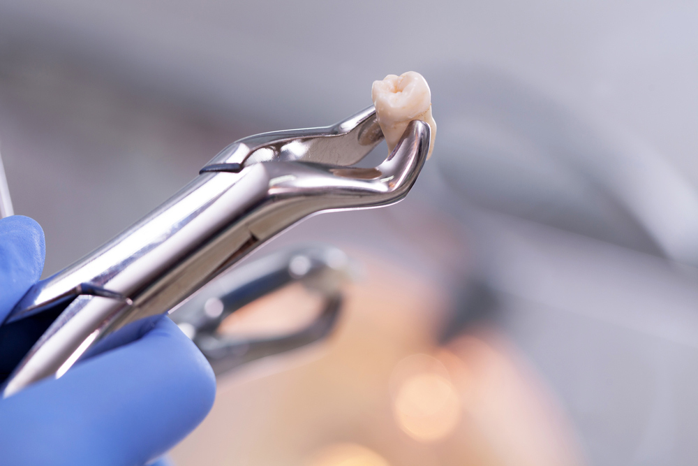 Holding A Removed Wisdom Tooth