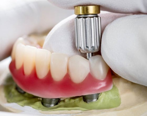 Close Up Image Of Dental Implant — Suncoastdental In Maroochydore, QLD