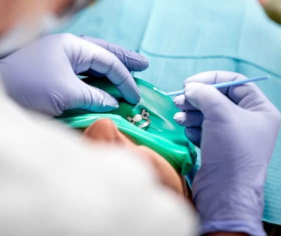 Patient Lying Down While Doing Dental Implant — Suncoastdental In Maroochydore, QLD