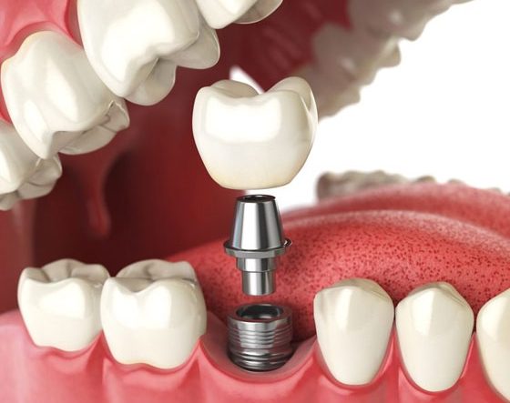 Dental Implant Procedure — Suncoastdental In Maroochydore, QLD