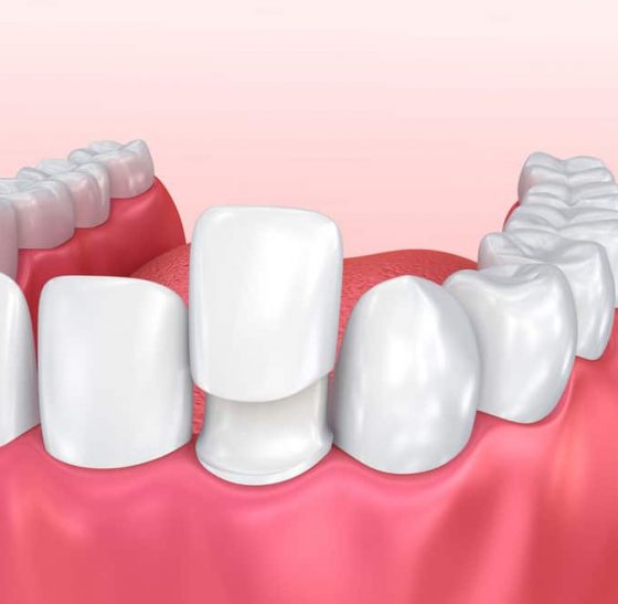 Dental Veneer Installation Procedure — Suncoastdental In Maroochydore, QLD