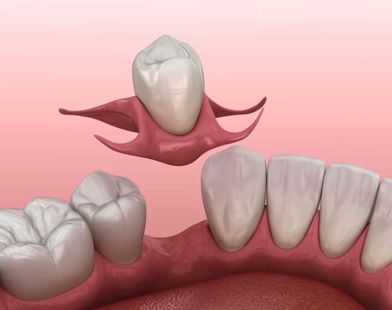 Single Piece Of Dentures — Suncoastdental In Maroochydore, QLD