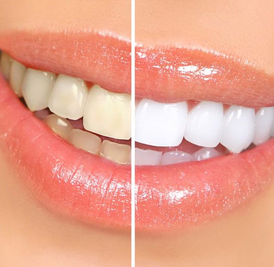 Teeth Whitening Procedure Before And After — Suncoastdental In Maroochydore, QLD