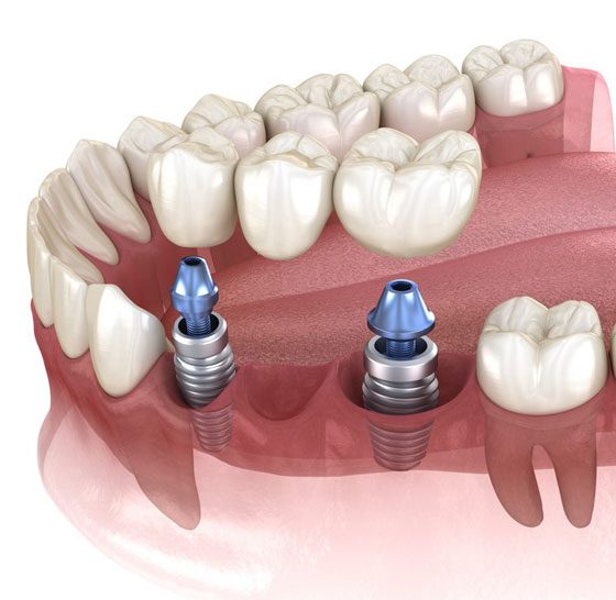 Dental Implant — Suncoastdental In Maroochydore, QLD