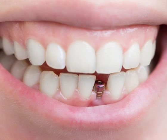 Dental Implant — Suncoastdental In Maroochydore, QLD