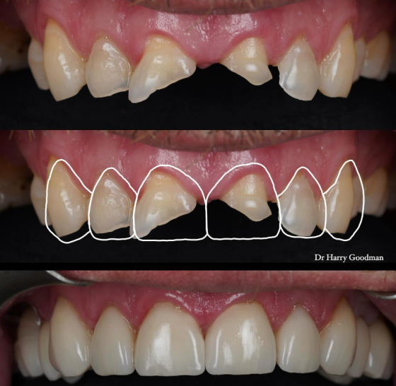 Dr Harry Goodman - Composite Veneer