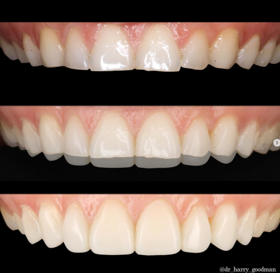 Dr Harry Goodman - Composite Veneer