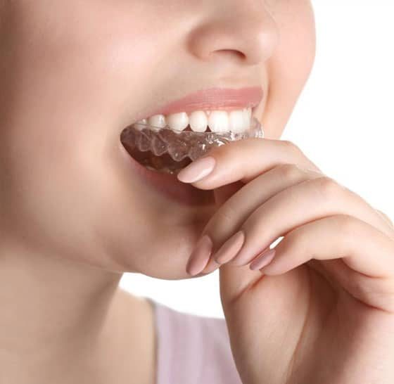 Women Fitting Her Splint — Suncoastdental In Maroochydore, QLD