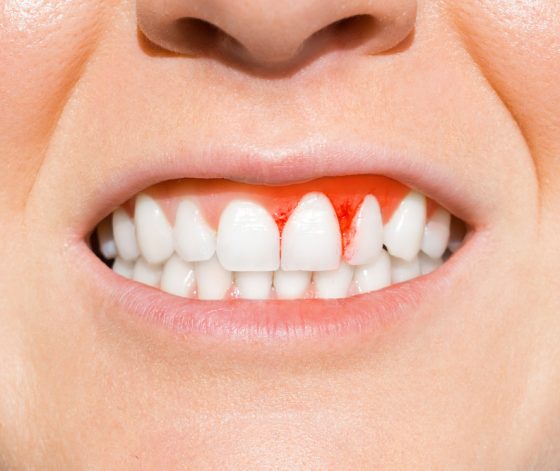 Woman With Bleeding Gums — Suncoast Dental In Maroochydore, QLD